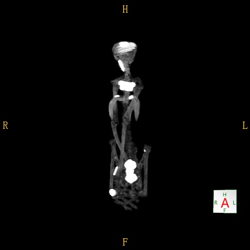 Joy ALADO 2 CT volume rendering