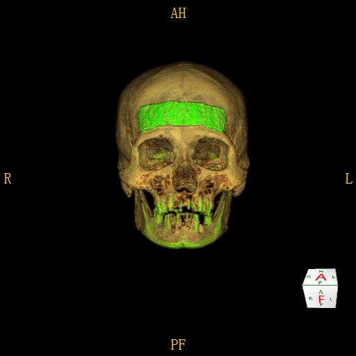 Loose skulls CABEZA 1 IMPLANTE CT volume rendering